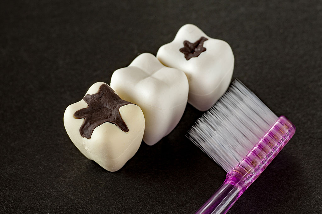 千葉県流山市・ほんだ歯科医院おおたかの森・むし歯の原因は？