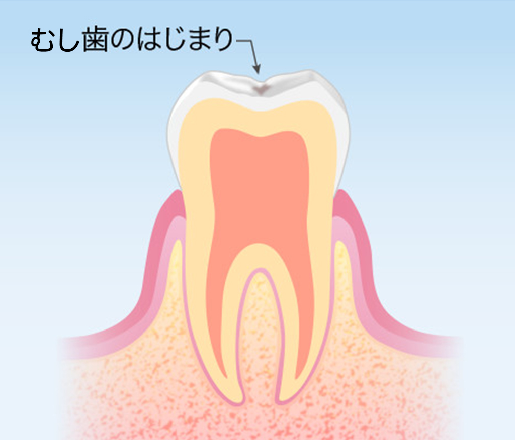 千葉県流山市・ほんだ歯科医院おおたかの森・初期むし歯