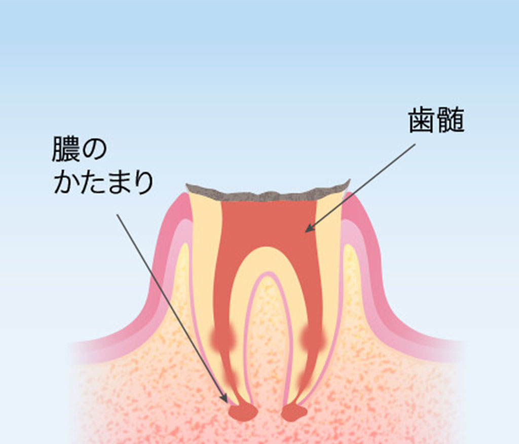 千葉県流山市・ほんだ歯科医院おおたかの森・歯根だけ残ったむし歯