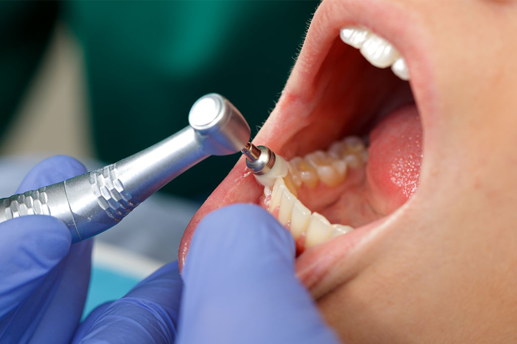 千葉県流山市・ほんだ歯科医院おおたかの森・クリーニング