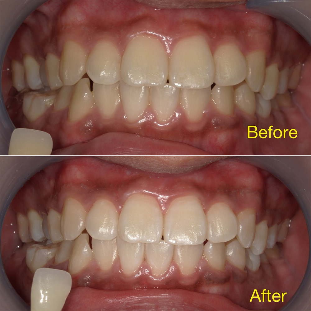 千葉県流山市・ほんだ歯科医院おおたかの森・治療例