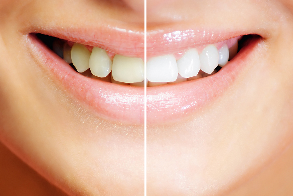 千葉県流山市・ほんだ歯科医院おおたかの森・ホワイトニング