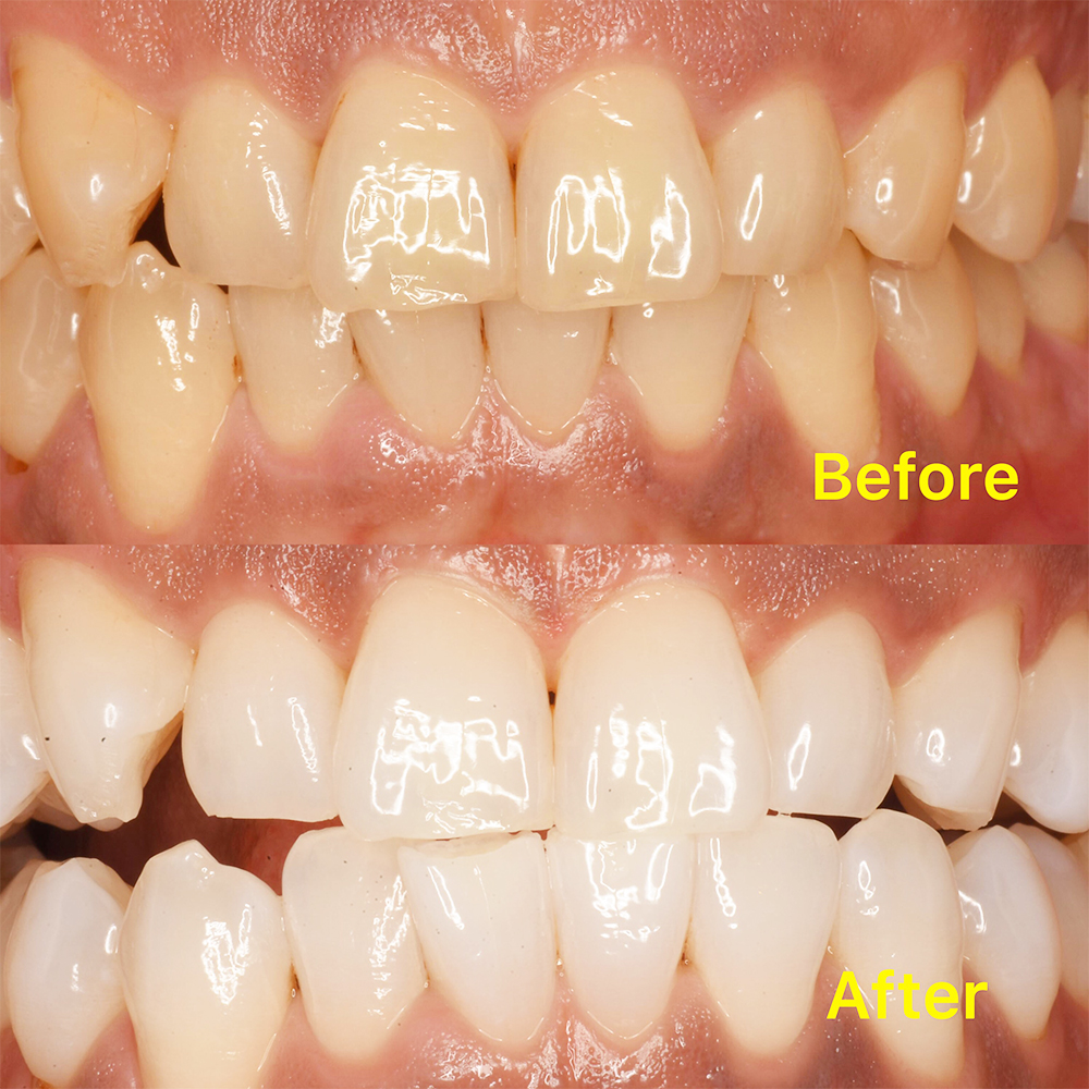 千葉県流山市・ほんだ歯科医院おおたかの森・治療例